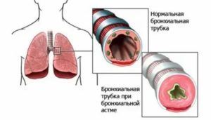 Заразна ли бронхиальная астма