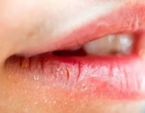 Заеды на губах у ребенка причины лечение