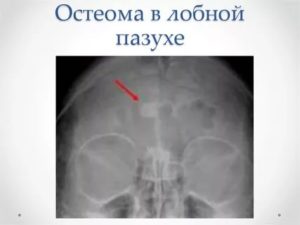 Остеома носовой пазухи