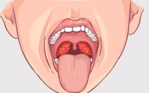 Боль в горле белый налет на языке
