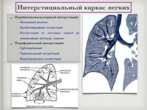 Интерстициальный компонент в легких что это