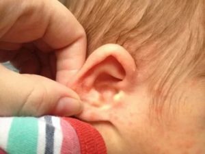 Ранки за ушами у ребенка