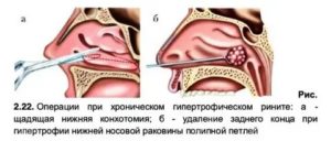Кровь в носу запекается при беременности