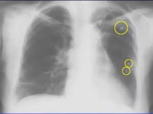 Видно ли на флюорографии пневмонию