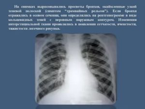 Рентгенологические признаки бронхита
