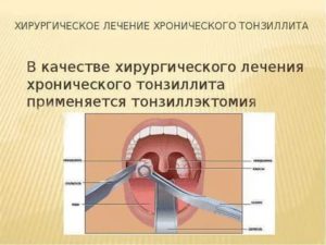 Полная декомпенсация миндалин что это