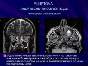 Мицетома верхнечелюстной пазухи