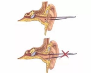 Ощущение инородного тела в ухе