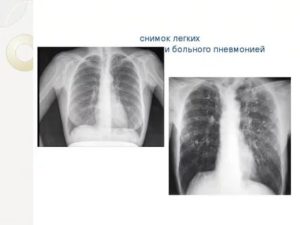 Рентгеновский снимок легких здорового человека