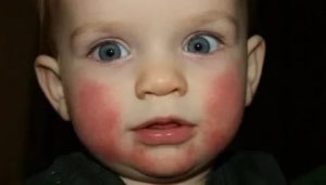 Почему у ребенка красные щечки