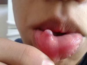 Белые язвочки на внутренней стороне губы