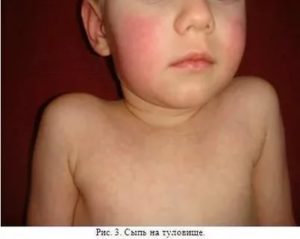 Сыпь при орви у ребенка фото