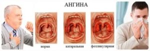 Катаральные явления верхних отделов дыхательных путей