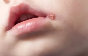 Болячка возле губы