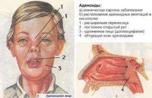 Аденоиды функция в организме