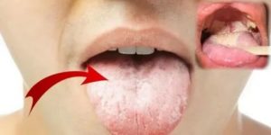 Чем полоскать рот при кандидозе ротовой полости