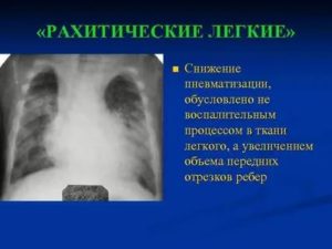 Легочные поля пневматизированы что это значит