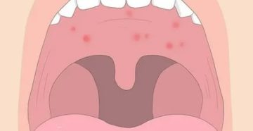 Налет на задней стенке глотки