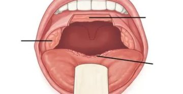 Парестезия глотки