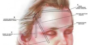 Болит над бровью при нажатии