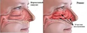 После гайморита не проходит заложенность носа