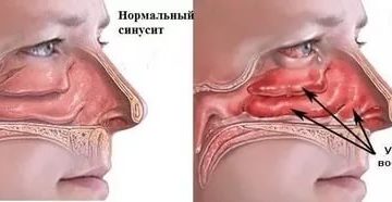 После гайморита не проходит заложенность носа