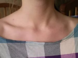 Надключичные лимфоузлы увеличены причины