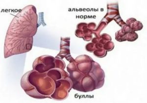 Буллы в легких причины