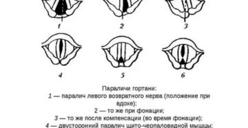 Парез левой половины гортани