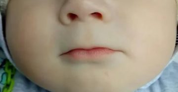 У ребенка синеет под носом У ребенка синеет под носом