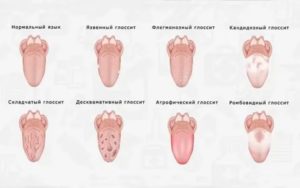 Лечение глоссита языка лекарствами