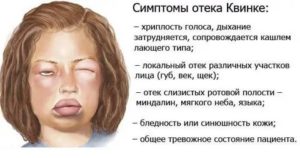 Отёк квинке симптомы и лечение у детей