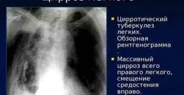 Цирроз легкого прогноз