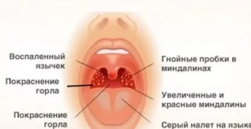 Можно ли мыться при ангине без температуры