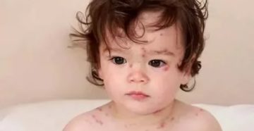 Сыпь при орви у ребенка фото Сыпь при орви у ребенка фото