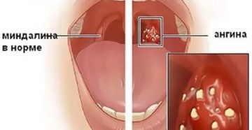 Кандидозная ангина лечение