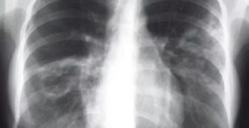 Плевропульмональные спайки в лёгких