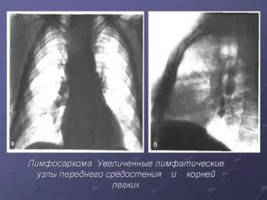 Увеличение лимфоузлов в легких причины