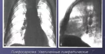 Увеличение лимфоузлов в легких причины