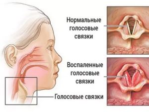 Лечение голосовых связок лекарствами