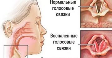 Лечение голосовых связок лекарствами