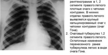Плотные очаги в легких что это
