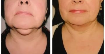 Припухлость под подбородком