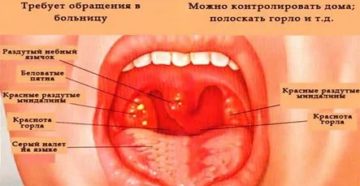 Можно ли в баню если болит горло
