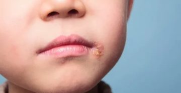 Болячка в уголке рта у ребенка Болячка в уголке рта у ребенка