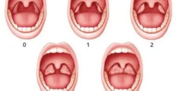 Подрезание миндалин у детей комаровский Подрезание миндалин у детей комаровский