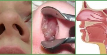 Заложена правая ноздря