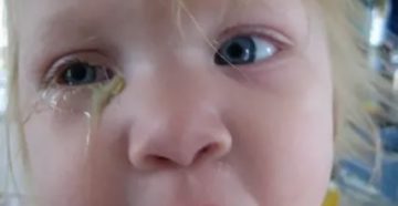 Сопли и гной из глаз у ребенка
