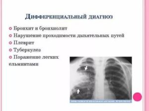 Как отличить туберкулез от бронхита