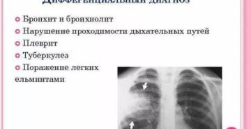 Как отличить туберкулез от бронхита